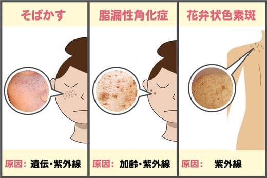 シミ取りクリームおすすめ