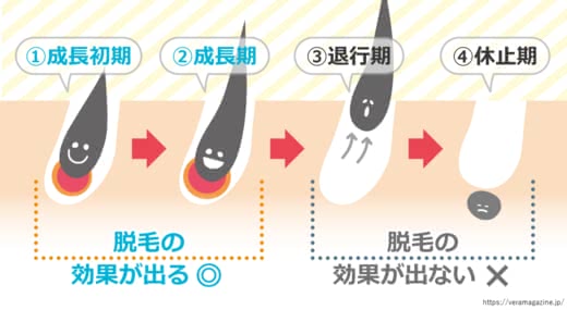 VIO脱毛,おすすめ