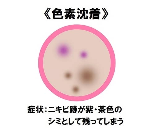 ニキビ治し方大人ニキビ早く治す