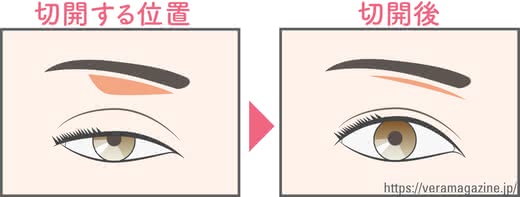 まぶたたるみ