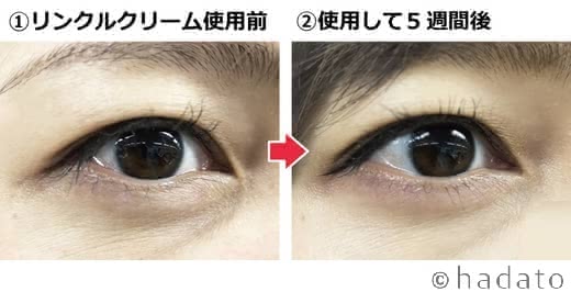 リンクルクリームシワ改善効果口コミ