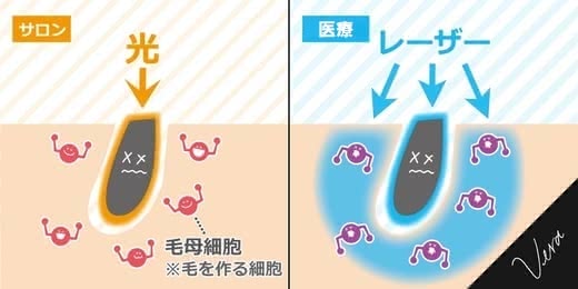 医療,脱毛,札幌