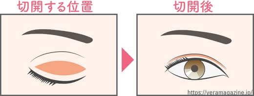 まぶたたるみ