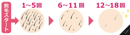 ひざ上脱毛