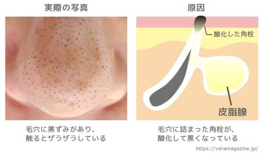 毛穴黒ずみ解消
